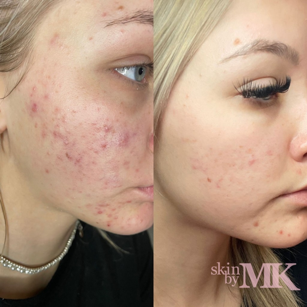 Client before and after skincare treatment photos